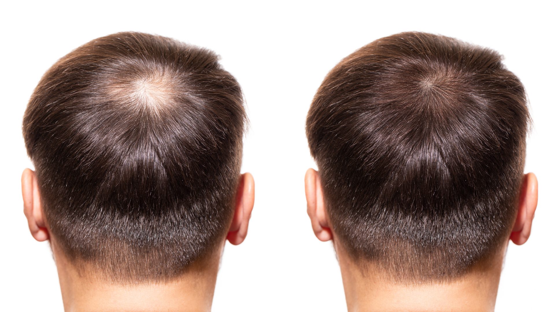 SEO for Hair Transplant Clinics